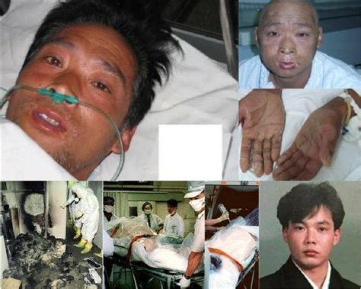 Hisashi Ouchi Photo: A Harrowing Glimpse into Radiation's Devastating Effects